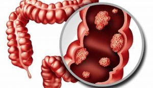 Illustrazione di un intestino (Depositphotos)