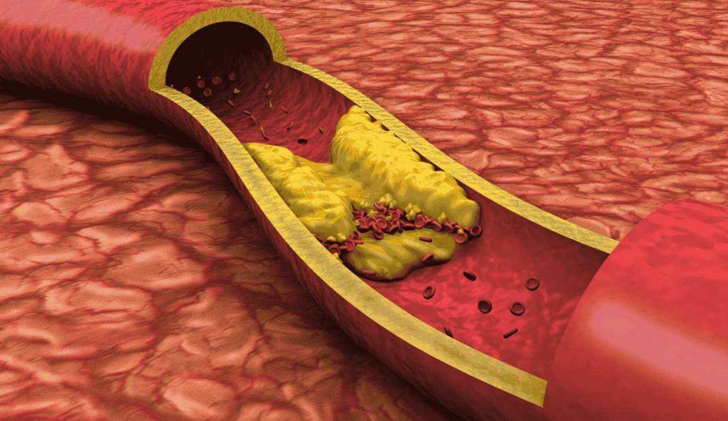 Arterie ostruite